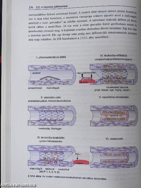 Atherosclerosis