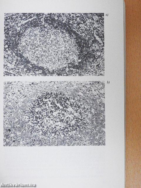 Non-Hodgkin lymphoma