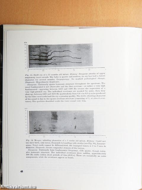 Pathological Cry Stridor and Cough in Infants - 2db lemezzel