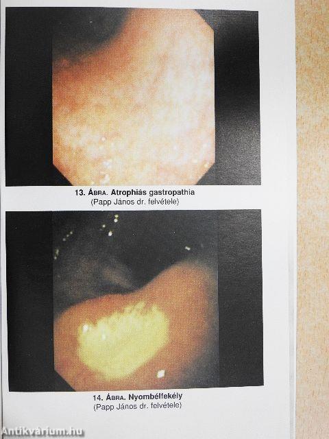 Gastro-oesophagealis reflux betegség, peptikus fekély és funkcionális dyspepsia