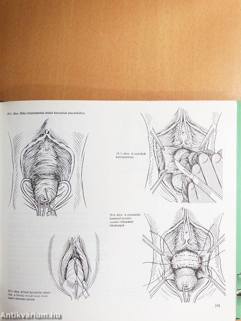 Szülészeti-nőgyógyászati műtéttan 2. (töredék)