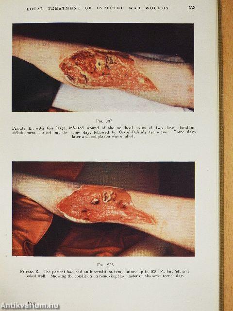 Surgery of Modern Warfare II. (töredék)