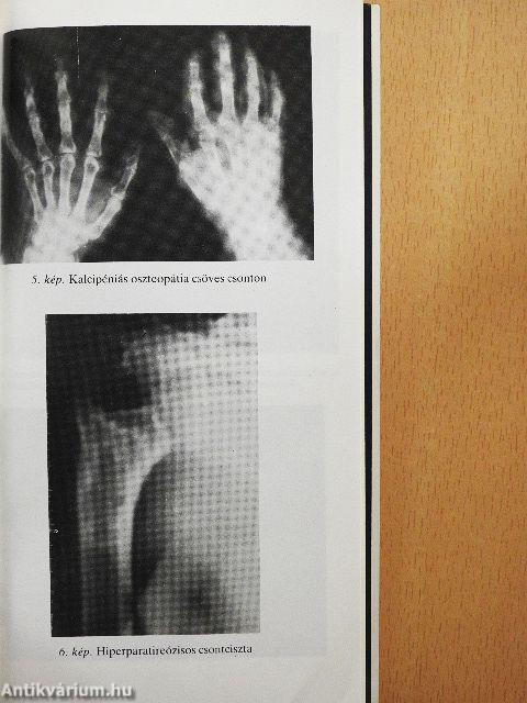 Anyagcsere-csontbetegségek a felnőttkorban