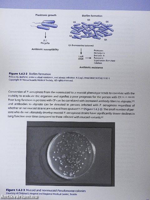 Unique Aspects of Cystic Fibrosis Respiratory Infections and Their Management