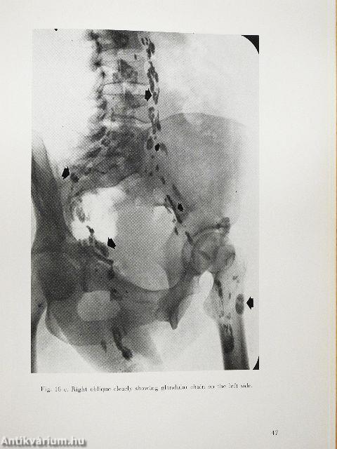 Lymphographic Differential Diagnosis of Neoplastic Diseases