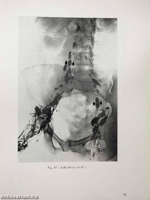 Lymphographic Differential Diagnosis of Neoplastic Diseases