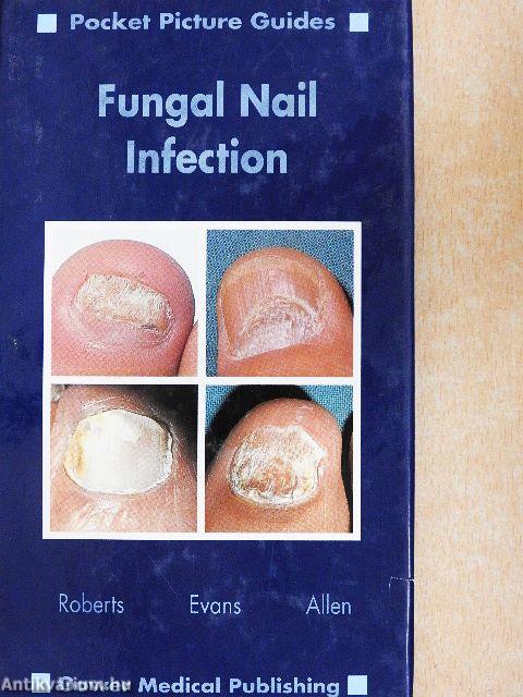 Fungal Nail Infection