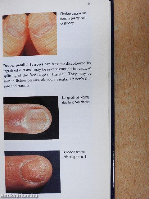 Fungal Nail Infection