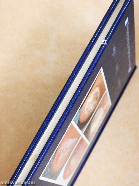 Fungal Nail Infection