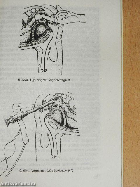 Tanácsok aranyeres betegeknek