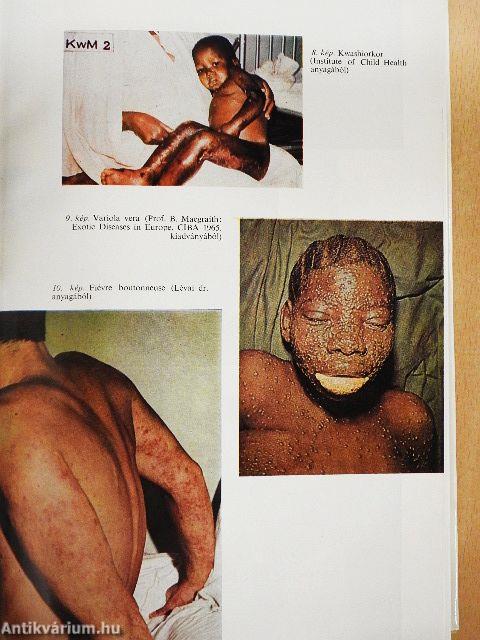 Trópusi betegségek