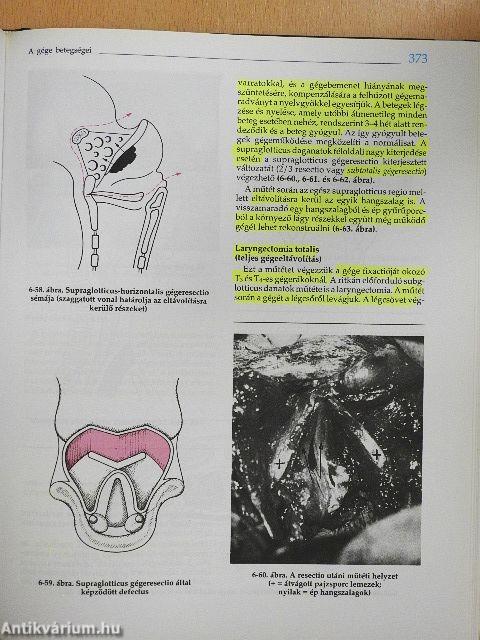 Fül-orr-gégészet, fej-nyak sebészet