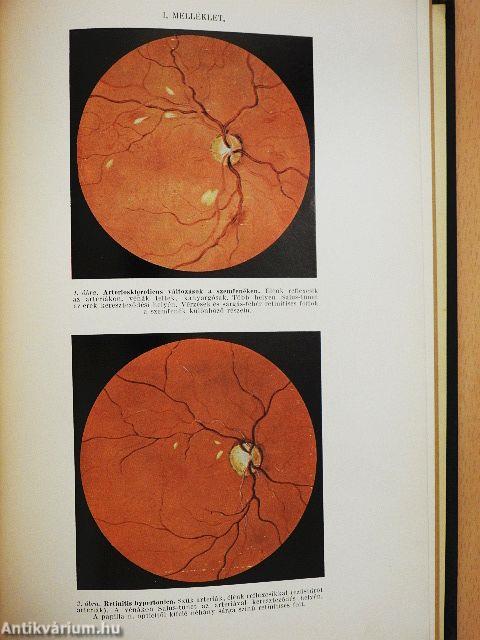 Hypertoniák és érbetegségek