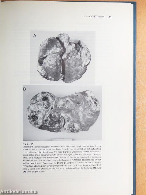 Tumors of the Newborn and Infant