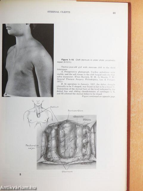 Congenital Deformities of the Chest Wall and Their Operative Correction