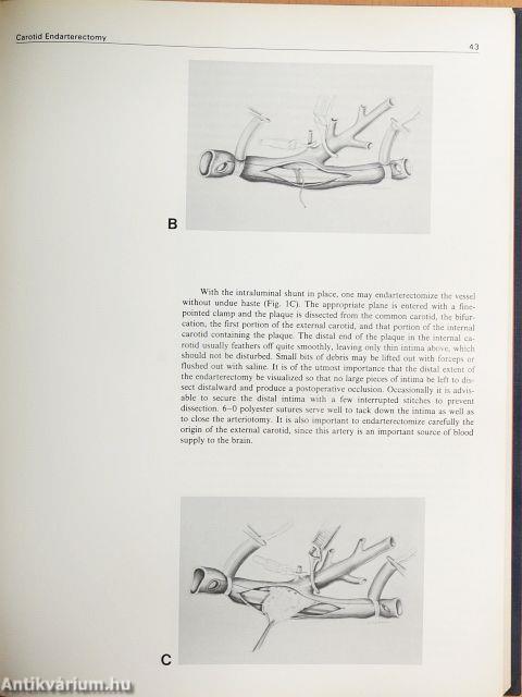Operative Techniques in Vascular Surgery