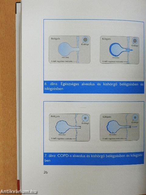 Fulladok, köhögök - COPD-s vagyok?