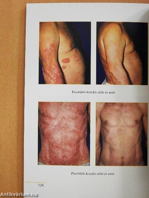 Pikkelysömör és ízületi gyulladás