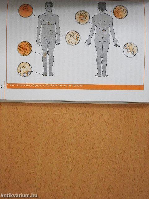 Pikkelysömör és ízületi gyulladás