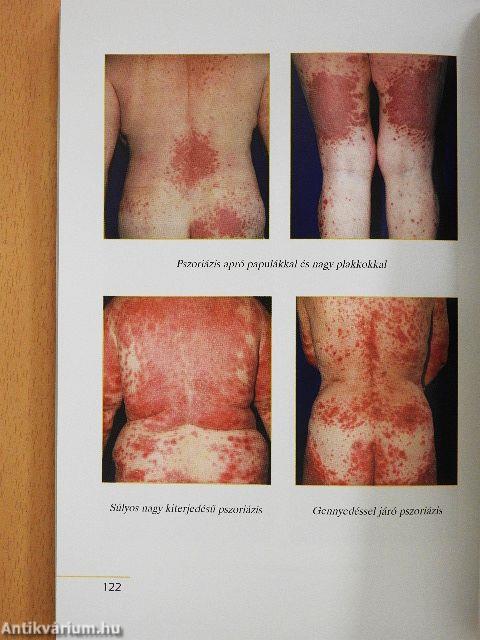 Pikkelysömör és ízületi gyulladás