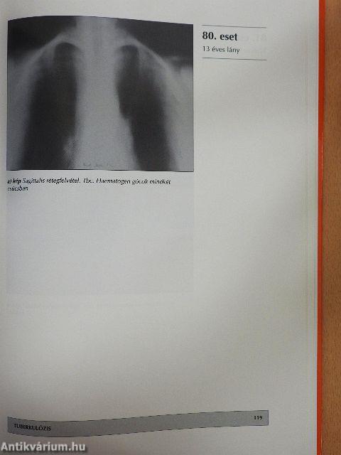 A gyermekkori tüdőbetegségek röntgenatlasza