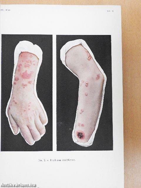 Atlas der Hautkrankheiten