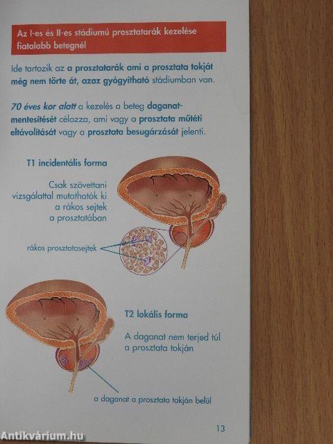 Prosztatarák a megszelídíthető daganat
