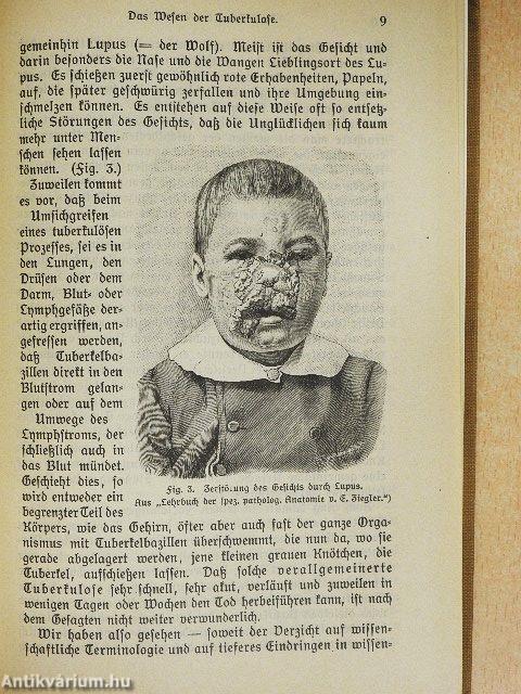 Die Tuberkulose (gótbetűs)