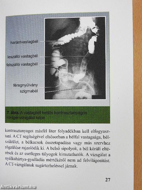 Gyulladásos bélbetegségek