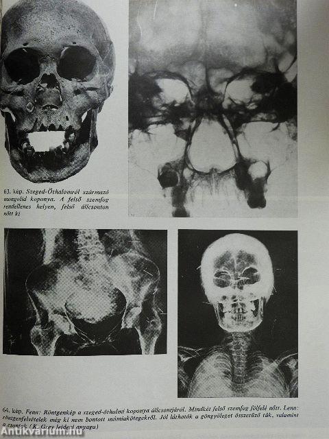 Sírok, csontok, emberek