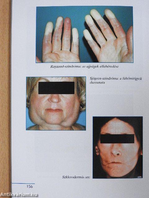 Autoimmun betegségek