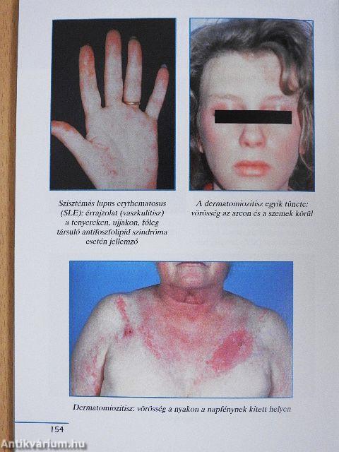 Autoimmun betegségek