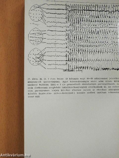 Az epilepszia mindennapi klinikai problémái