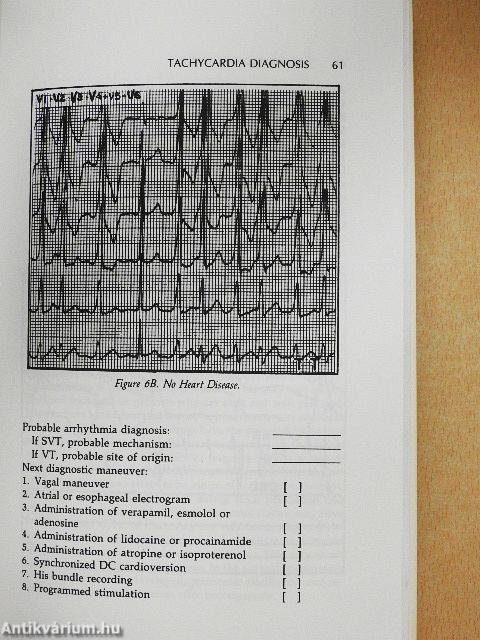 Tachycardia