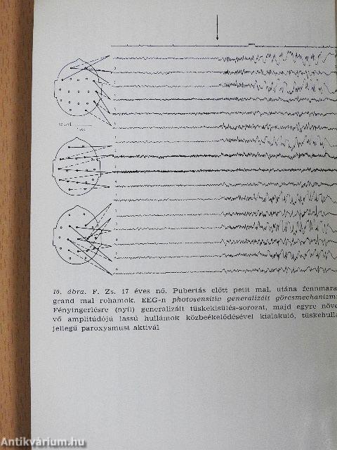Az epilepszia mindennapi klinikai problémái