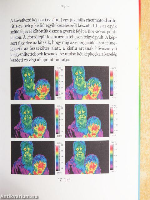 Hőkamerával az akupunktúra nyomában