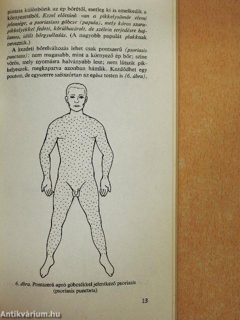 A pikkelysömörről