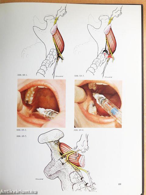 Techniken der Regionalanästhesie