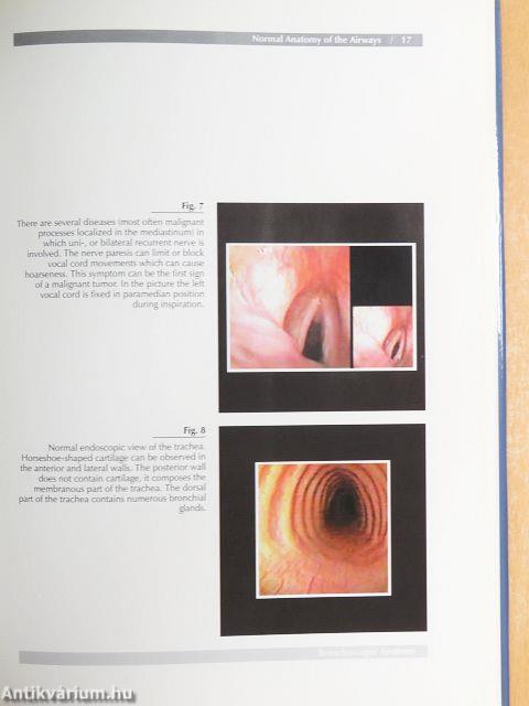 Bronchoscopic Aspects of Human Lung Diseases