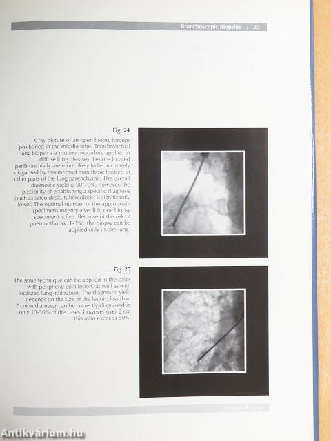 Bronchoscopic Aspects of Human Lung Diseases