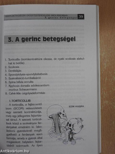 Gerincbetegségek gyógytestnevelése iskoláskorban