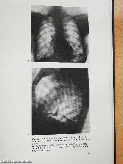 Légzésrehabilitáció
