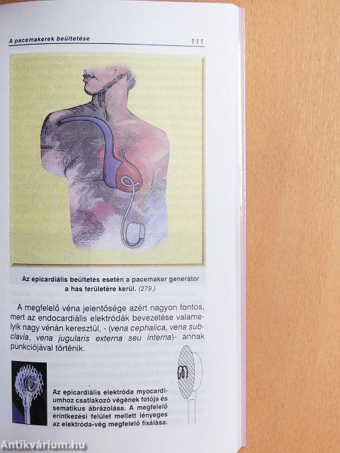 Amit a Pacemaker-ről tudni kell