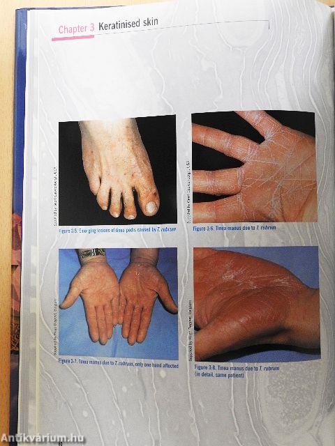 Fighting fungal infections around the globe