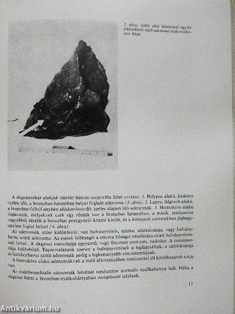 A tüdő jóindulatú daganatai