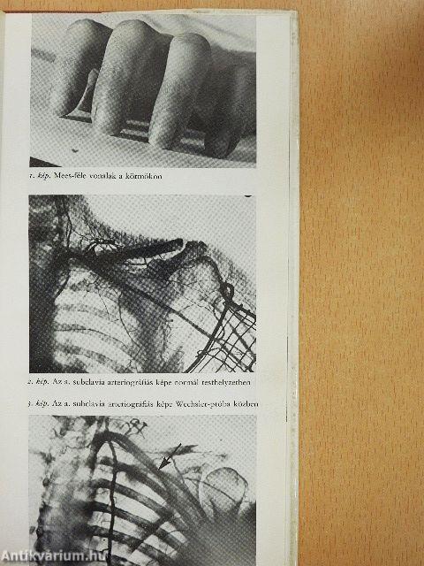 Alagút-szindrómák