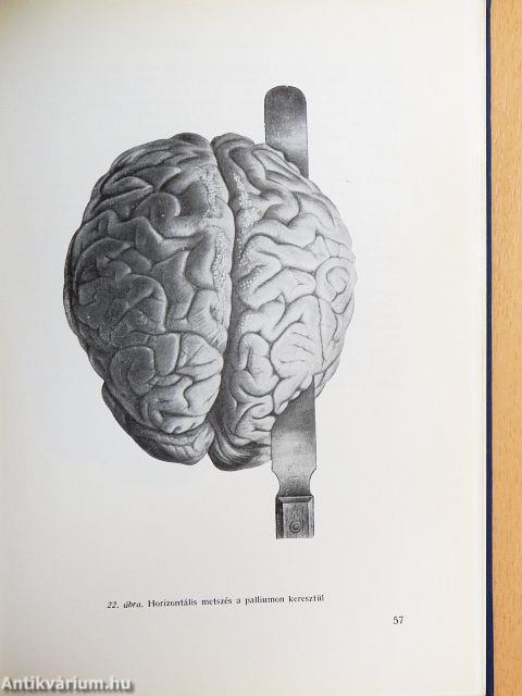 Az agyvelő boncolása