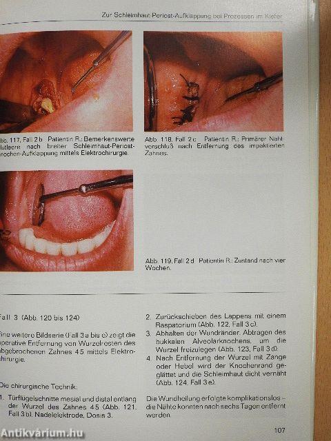 Elektrochirurgie in der Zahnheilkunde