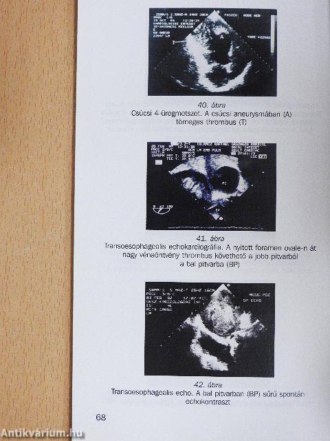 Mindennapi echokardiográfia