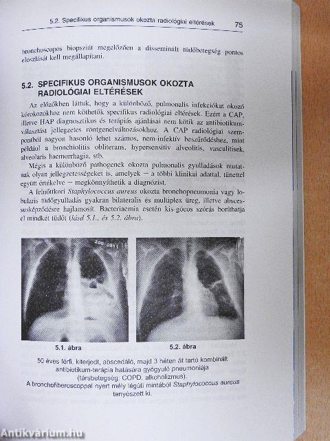 Alsó légúti infekciók felnőttkorban
